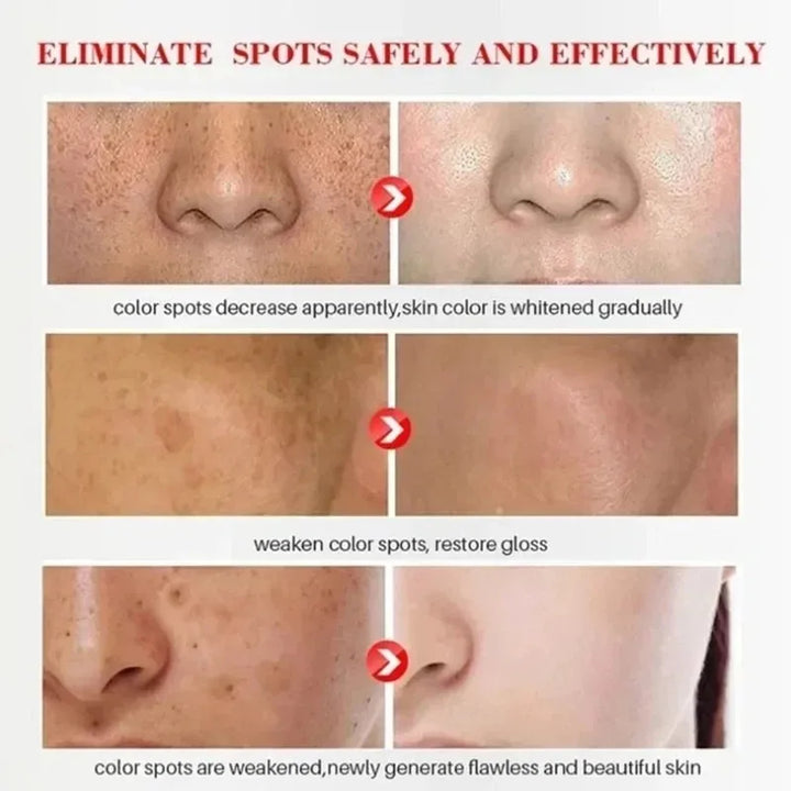 Crema blanqueadora para pecas, elimina manchas oscura y atenua la pigmentacion 20g
